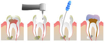 Root Canals