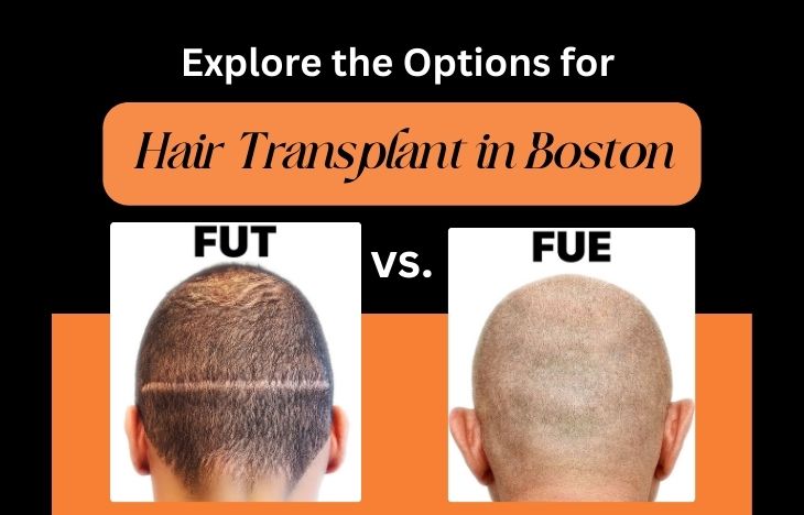 Explore-the-Options-for-Hair-Transplant-in-Boston-FUT-vs.-FUE