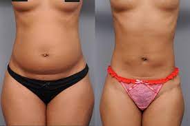 lipo laser nyc