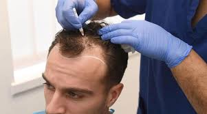 best hair transplant in lahore